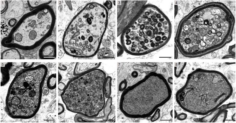 The image series shows cross-sectional electron micrographs of individual nerve fibers in MS brain biopsies. Axons sheathed with myelin (black rings) can be seen, showing increasingly severe damage from 1 to 8. The spectrum ranges from accumulation of individual cellular components in otherwise still bright, intact axons (1) to advanced degeneration in dark irreversibly damaged axons (8). Photo: Leipzig University